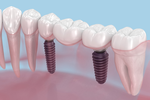 Dental Implant Recovery: What To Expect After The Procedure