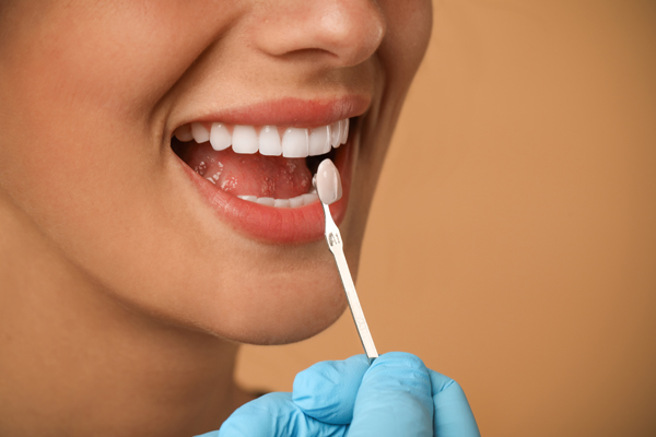 Signs You Are A Candidate For Dental Veneers