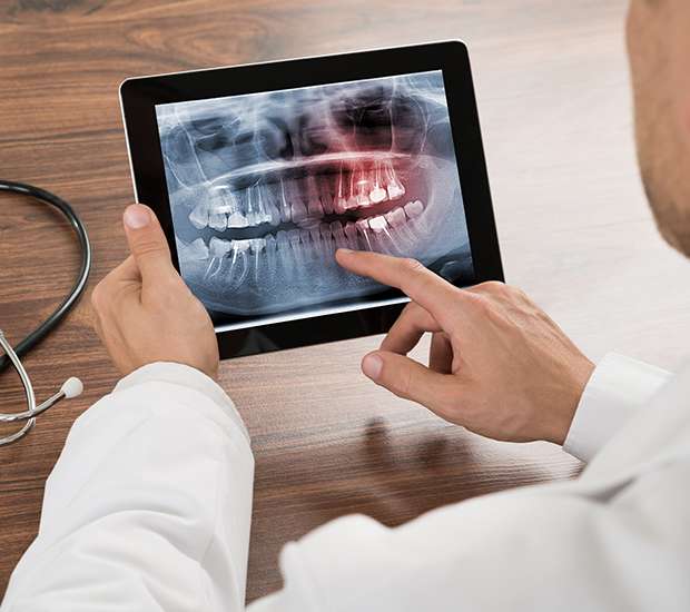 Newport Beach Types of Dental Root Fractures